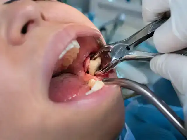 Wisdom Tooth Extraction treatments at Brush & Floss Dental Clinic Rawalpindi