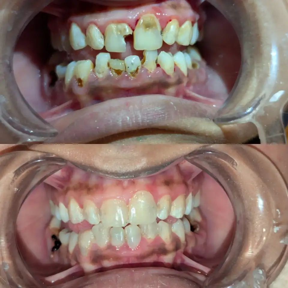 Dental Fillings treatment result at Brush & Floss Dental Clinic Rawalpindi