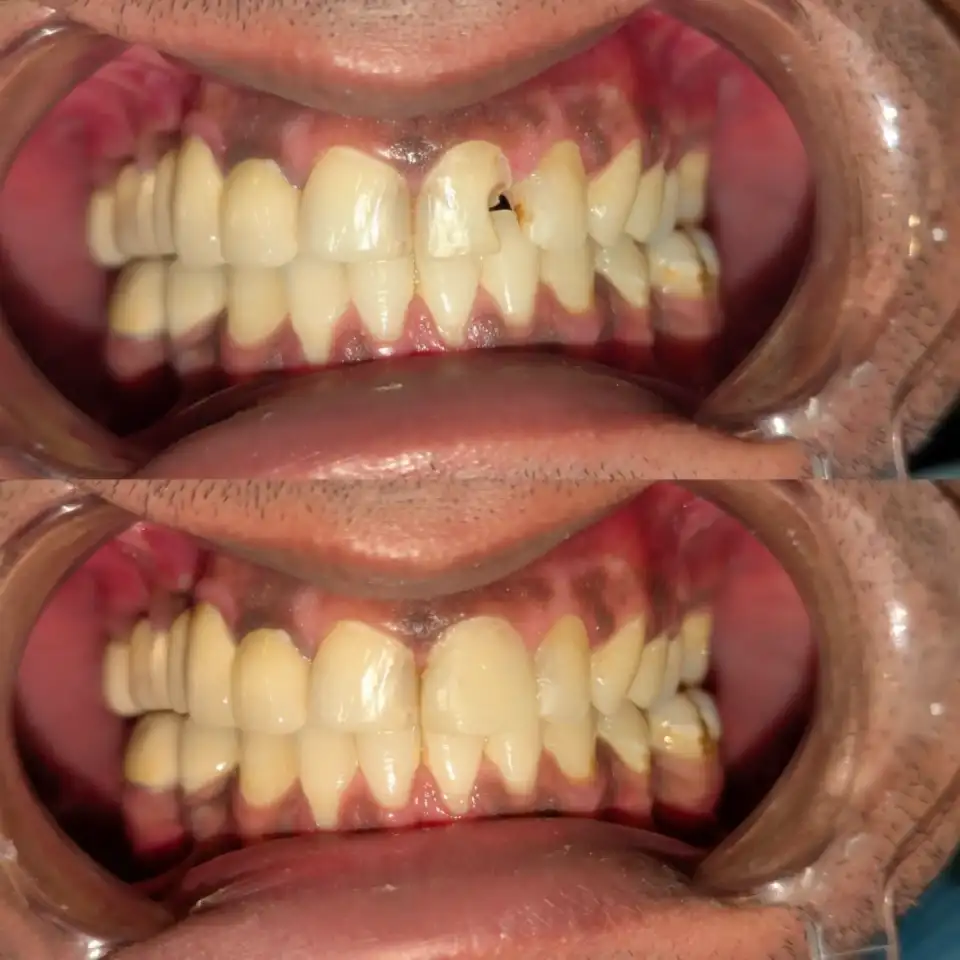 Dental Fillings treatment result at Brush & Floss Dental Clinic Rawalpindi