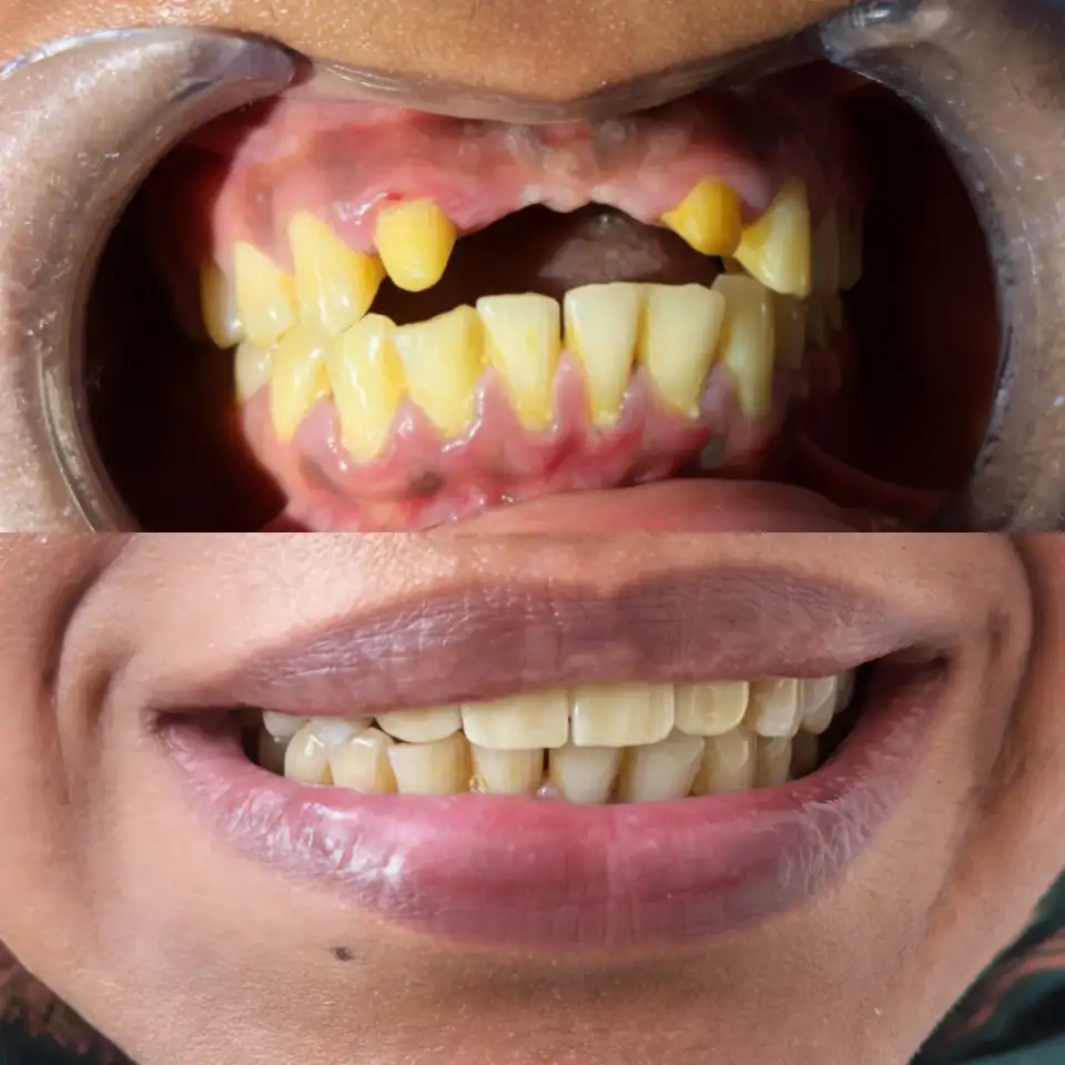 Dental Bridges treatment result at Brush & Floss Dental Clinic Rawalpindi