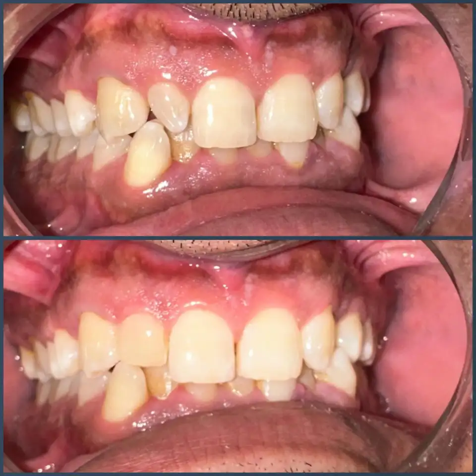 Braces and Orthodontics treatment result at Brush & Floss Dental Clinic Rawalpindi