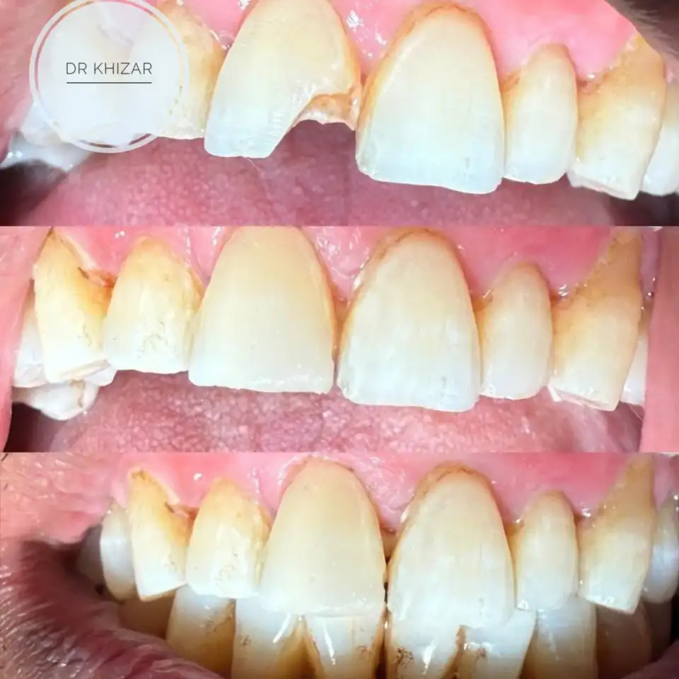 Dental Fillings treatment result at Brush & Floss Dental Clinic Rawalpindi