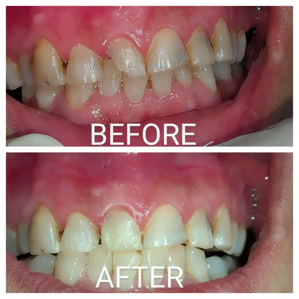 Before and after treatment result