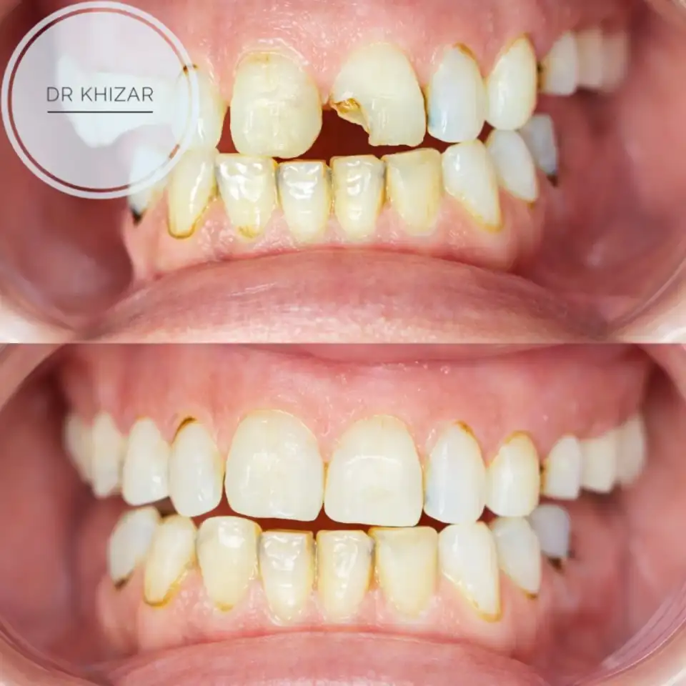 Dental Fillings treatment result at Brush & Floss Dental Clinic Rawalpindi